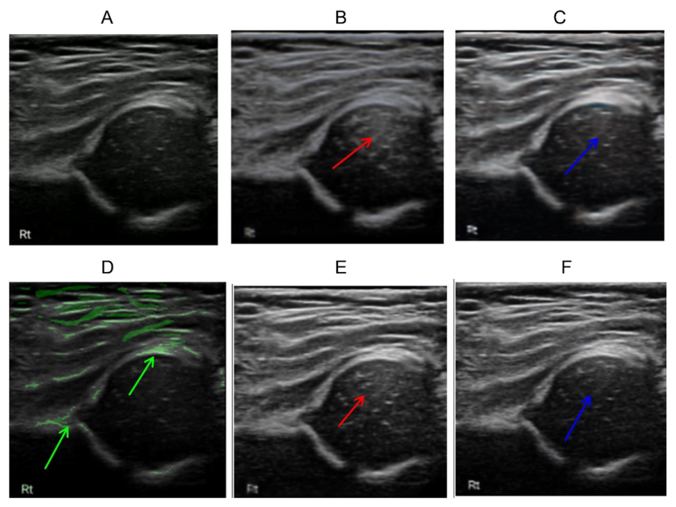 D-CUT domain translation results comparing Lumify input with pseudo-3DUS output and iU22 ground truth for infant hip imaging