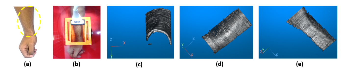 In-vivo results. A human forearm with the scan region circled, the forearm being scanned through the printed track in the water bath, and three views of the reconstructed volume of the radius bone.