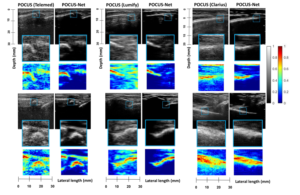 POCUS-Net results across Telemed, Lumify, and Clarius probes showing enhanced bone visualization