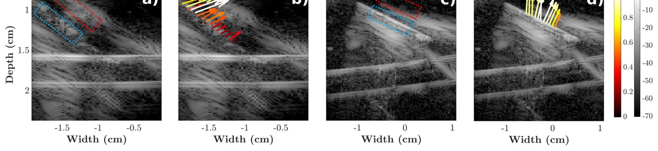 TSDI applied to a needle inserted into a gel phantom with a blood vessel mimicking setup.