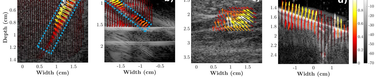 TSDI applied over larger regions in k-Wave, needle, brachioradialis and bone datasets.