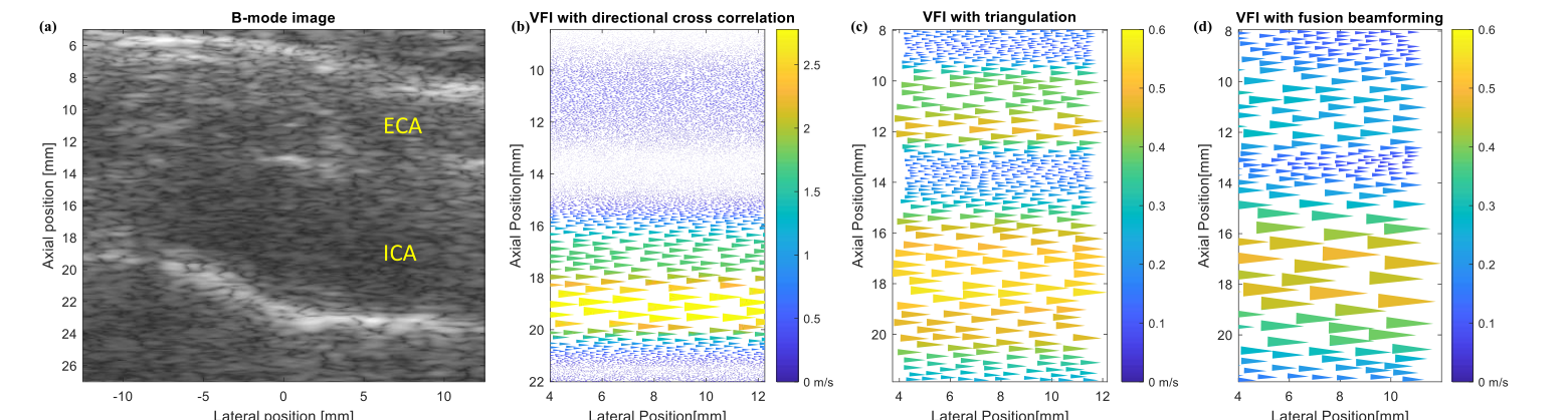 In-vivo carotid bifurcation B-mode image and vector flow images from directional cross correlation, triangulation and fusion beamforming
