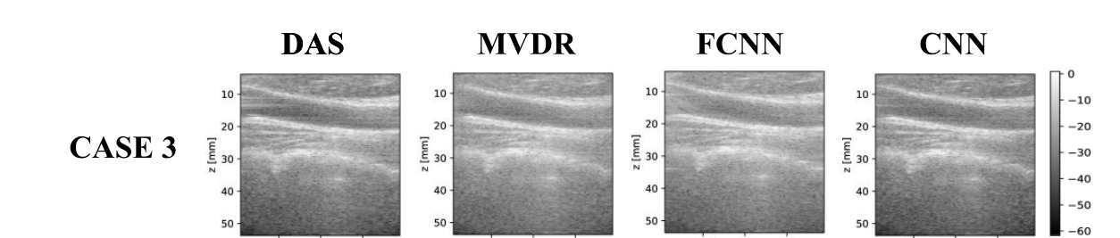 B-mode images of a carotid longitudinal section from the PICMUS dataset beamformed with DAS, MVDR, FCNN and the proposed CNN.
