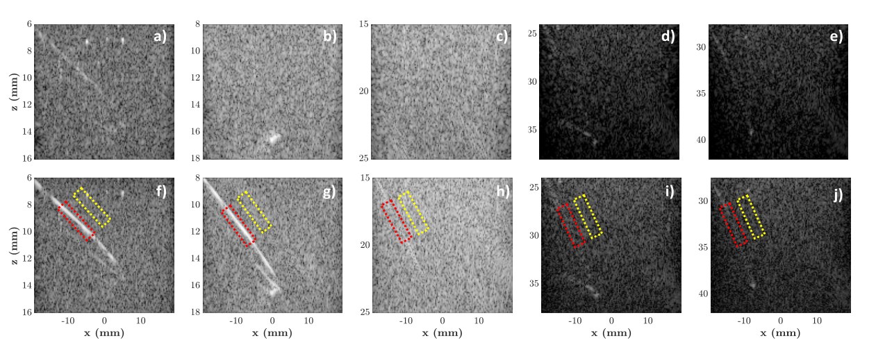 B-mode images of needle insertions in a gel phantom with added speckle noise for plane wave and synthetic transmit aperture transmissions at five insertion angles.