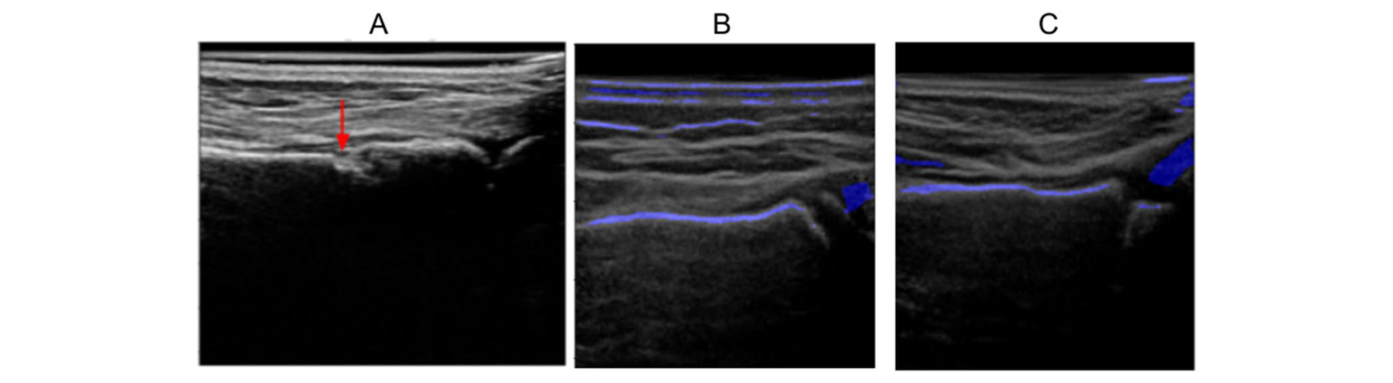 Normal and fractured pediatric wrist ultrasound with POCUS-Net enhancement