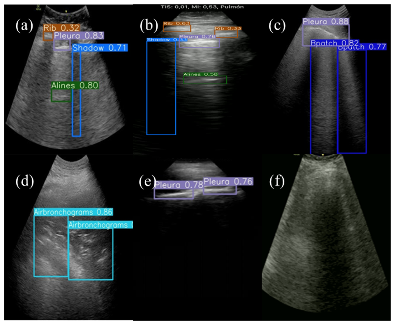 Six lung ultrasound frames from different machines and probes with YOLOv5 bounding boxes and confidence scores over rib, pleura, shadow, A-lines, B-patch and air bronchogram detections.
