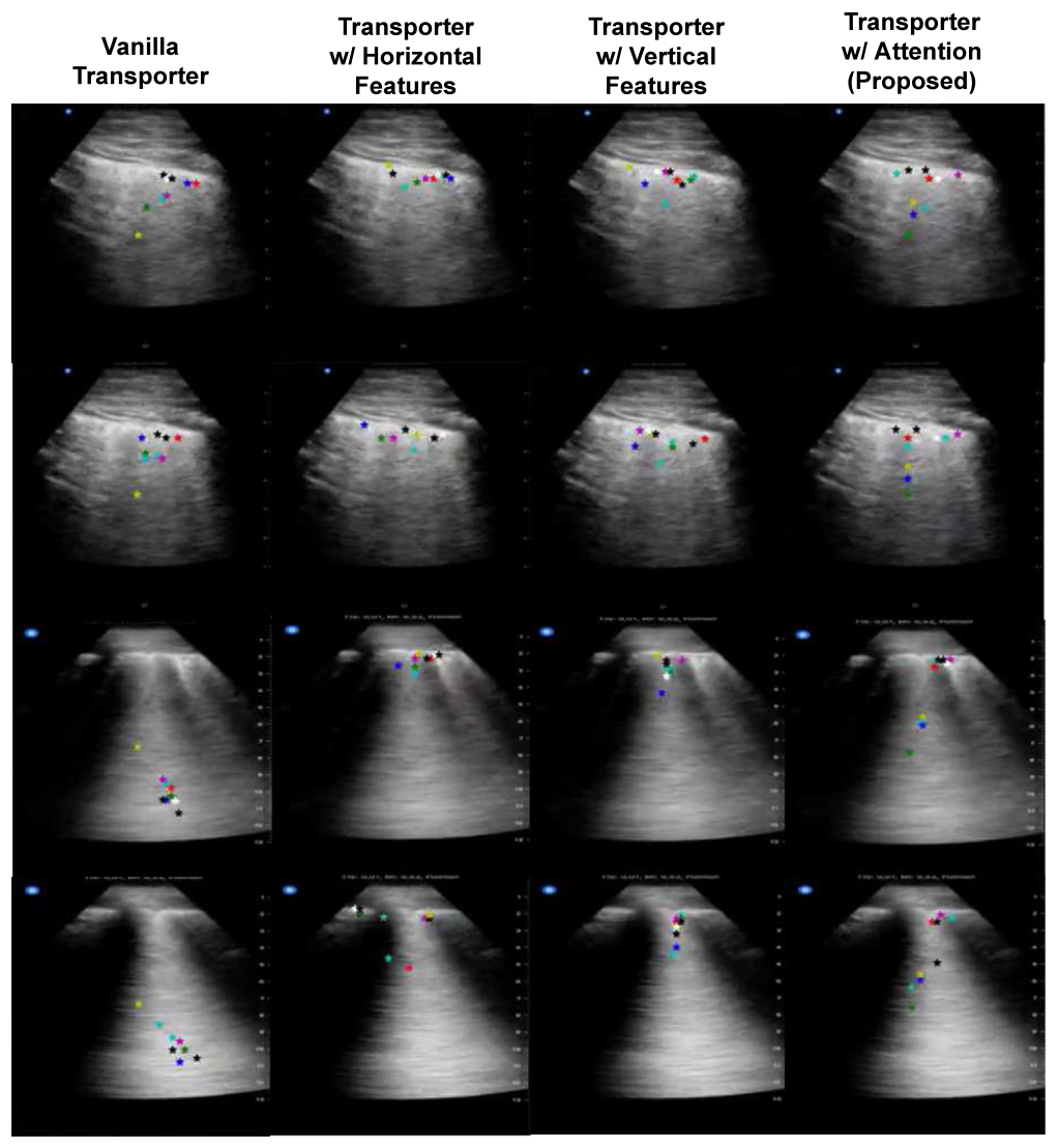 Four lung ultrasound frames each processed by four transporter variants: vanilla transporter, transporter with horizontal features only, with vertical features only, and with the proposed attention mechanism. Coloured star markers show keypoint locations, which cluster tightly on pleura and B-lines only in the attention column.